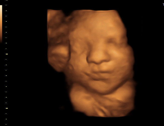 3D ultrasound image at 31 weeks